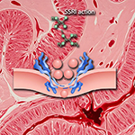 SSRIs Linked to GI Bleeding, Study Finds