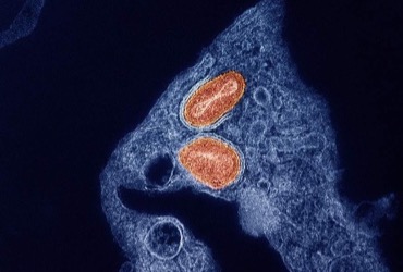 NIH Ends Study of Tecovirimat as Mpox Pain Treatment