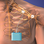 PNS Shows Promise Treating Chronic Shoulder Pain