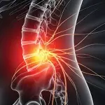 SCS Showing Promise for Managing Low Back Pain